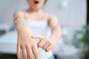 水痘